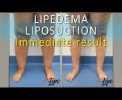Lipedema Liposuction Surgery by Dr. Thomas Su