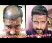 Mass Bakyaraj HT / தமிழ் Hair Transplant