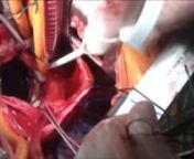 Koltukaltından 2. Aort Mitral Kapak Ameliyatı - Op.Dr.Mahmut Akyıldız from aort