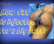 How fat is injected into the buttocks for a Brazilian butt lift procedure.nnHi, this is Dr. Hourglass, and today we are going to discuss how fat is injected into the buttocks for a buttock enhancement procedure. nnWith the Brazilian butt augmentation, or the hourglass butt augmentation, as I like to describe it, fat is removed from multiple areas. This fat is processed and then injected into the buttocks in multiple passes to achieve a good result. So, how does a surgeon perform this procedure?