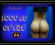 1,000 cc of fat in each buttock during a Brazilian butt liftnnEverybody likes the number 1,000 cc when we talk about the Brazilian buttock augmentation. There is a misconception that this is the magic number to get the best results. In addition, most patients think that it is very easy to harvest such an amount of fat. nnLet’s discuss how much 1,000 cc is. If we look closely, 1,000 cc means 1 L. Injecting 1 liter of pure fat on each side, not counting the hips, is a daunting task. To achieve t