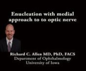 This is Richard Allen at the University of Iowa. This video demonstrates enucleation with placement of a porous polyethylene implant with approach to the optic nerve from the medial direction.The patient had a choroidal melanoma.A 360 degree conjunctival peritemy is performed with Westcott scissors.This followed by dissection into each of the quandrants between the rectus muscles with Stevens scissors.The medial rectus muscle is then hooked with a Von Graefe muscle hook.This is then tr