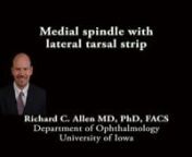 This is Richard Allen at the University of Iowa. This video demonstrates repair of medial involutional ectropion with a lateral tarsal strip and medial spindle.A lateral canthotmy and inferior cantholysis are performed to prepare the lateral tarsal strip.Westcott scissors are then used to dissect between the anterior and posterior lamella for approximately 5-7 mm. The mucocutaneous junction of the posterior lamella is then excised with the Westcott scissors.The posterior surface of the p