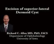 This is Richard Allen at the University of Iowa. This video demonstrates the use of an upper eyelid crease incision for removal of a superior lateral presumed dermoid cyst.A monopolar cautery is used to make an incision along the upper eyelid crease.Dissection is then performed through the orbicularis muscle to expose the orbital septum.Dissection is then carried out between the orbicularis muscle and the orbital septum superiorly toward the superior orbital rim.Dermoid cysts in this are