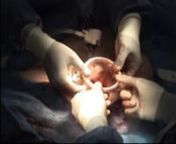 This video shows a laparoscopic procedure involving a small bowel retraction technique using the endoractor® to displace the intestine away from the operative field. The endoractor® is a highly hygroscopic cellulose compressed sponge, that expands nconsiderably once physiological normal saline has been added, and can be used to ‘pack’ the small bowel away from the pelvis, negating the requirement for the steep head down nposition. It can be inserted through a 10mm trocar and then removed t