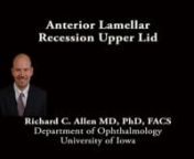 This is Richard Allen at the University of Iowa.This video demonstrates repair of cicatricial entropion of the upper eyelid using an anterior lamellar recession with excision of the lashes. The patient has a history of mucous membrane pemphigoid.Using a 15 blade, an incision is made along the eyelid margin at the grey line to separate the anterior and posterior lamella. This is performed along the length of the eyelid.Westcott scissors are then used to further separate the anterior and pos