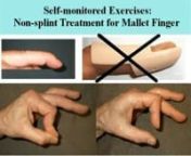 This video illustrates mallet finger non-splint treatment with an exercise technique developed by Valdas Macionis, MD, PhD.The technique is based on frequent hold-relax tip-to-tip power pinch exercises. Splint and surgery related problems can be avoided.Complete or almost complete recovery of extension can be achieved. The technique does not preclude further splinting or surgical tendon repair.nMallet finger is a deformity caused by traumatic loss of continuity between the extensor apparatus