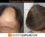 Paciente de 49 años con Alopecia MBP NW V y antecedentes de cirugía por lo que presenta cicatriz fronto temporal con depleción de zonas temporoparietales.Donante segura en occipitoparietal (173 cm2), lo que implica cirugías más pequeñas. Cosmética y poder de cobertura bajo por pelo fino y graso. nnCaracterísticas donante (2ªcirugía):nn· Occipital: 47 micras; 73 FU/cm2; 173 pelos/cm2; CV de 8,13nnSe realiza una primera intervención de 2401 grafts a 2,42 pelos/graft con bisturí de 0