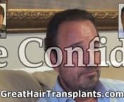 Original Video @ https://www.youtube.com/watch?v=XyX4QDjtt70nnThis patient had 3 previous hair transplants with other doctors and was not happy.He came to Great Hair Transplants for Dr. Bolton&#39;s unprecedented MaxHarvest™ procedure which is neither FUE or FUT but yields much more hair leaving an undetectable scar.If you would like to know more about MaxHarvest visit our website at http://www.greathairtransplants.com/ or Call Now @ (954) 567 - 5868 nnCheck more @ https://www.greathairtranspl