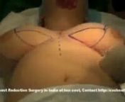 Breast Reduction surgery in India from get plastic surgery for free