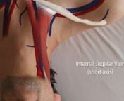Central Venous Catheter Insertion GuidenInternal jugular vein cannulation with a central venous catheter using short axis ultrasound guidance.