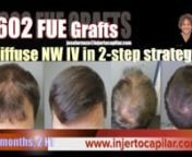Paciente de 39 años en tratamiento hace 2 años con baja dosis de finasteride (5 mg/semana). En el límite de realizar una estrategia a 2 cirugías, se decide intentar el mejor resultado en 1 cirugía y evaluar posteriormente. nZona donante con las siguientes características: n- Temporal: 50 μm de pelo; 80 UF/cm2; 188 pelos/cm2; 2,35 pelos/UF; CV de 9,40. n- Parietal: 51 μm de pelo; 98 UF/cm2; 230 pelos/cm2; 2,35 pelos/UF; CV de 11,73. nn- Occipital: 52 μm de pelo; 89 UF/cm2; 220 pelos/cm2;