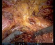 This is a patient who has had multiple abdominal surgeries including a small bowel resection as a child, an open Retrocolic RNY gastric bypass plus a subsequent laparoscopic IPOM epigastric incisional hernia repair.The bypass surgery was with a nondivided partioned stomach using the TA stapler.She had subsequent weight regain despite optimizing her lifestyle. An Gastric-gastric fistula was confirmed on EGD and upper GI. This video has been minimally edited except for instrument exchanges and