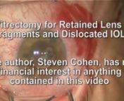 This video shows the removal of lens fragments from an eye with iris fixation of the intraocular lens.The patient regained normal vision within about 1 month of the surgery with no complications.Lens fragment surgery is sometimes necessary following cataract surgery if lens material enters the posterior pole - vitreous - of the eye during cataract extraction.