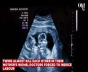Twins almost kill each other in their mother's womb, doctors forced to induce labour from tarlington twins