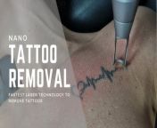 Using our advanced Nano technology it&#39;s now quicker to remove unwanted tattoos.